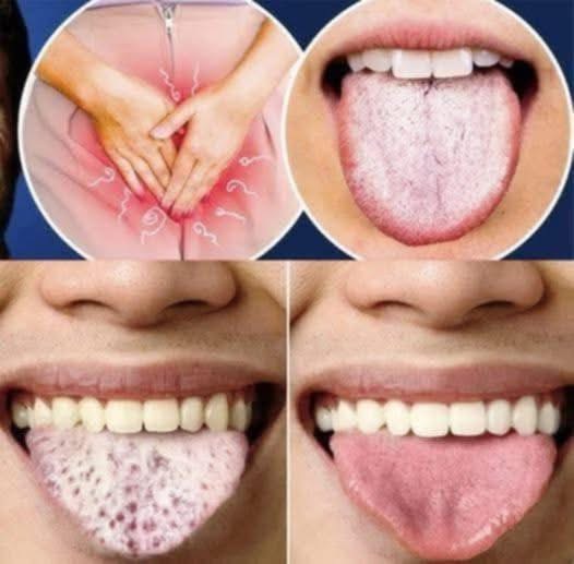 What Your Tongue Says About Your Health: 4 Warning Signs to Watch For